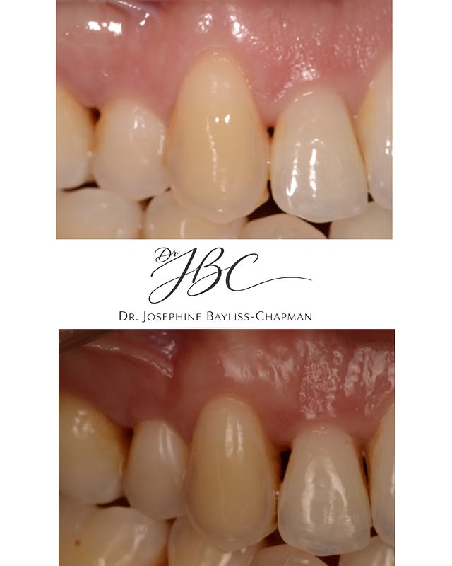 Before Periodontal Treatment