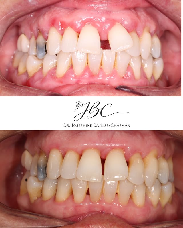 After Periodontal Treatment